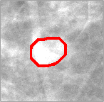 A detected mass, initially missed by the radiologist.